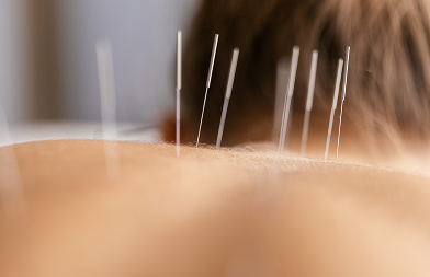 Acupuncture